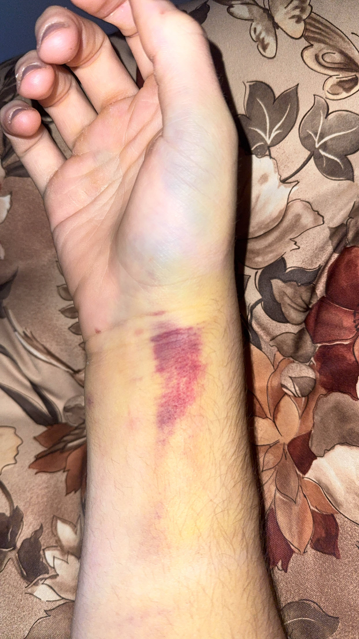 Injured Wrist